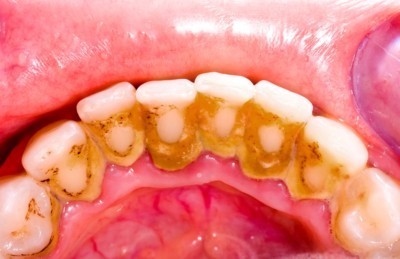 جرم دندان