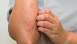 اگزما (eczema) چیست؟